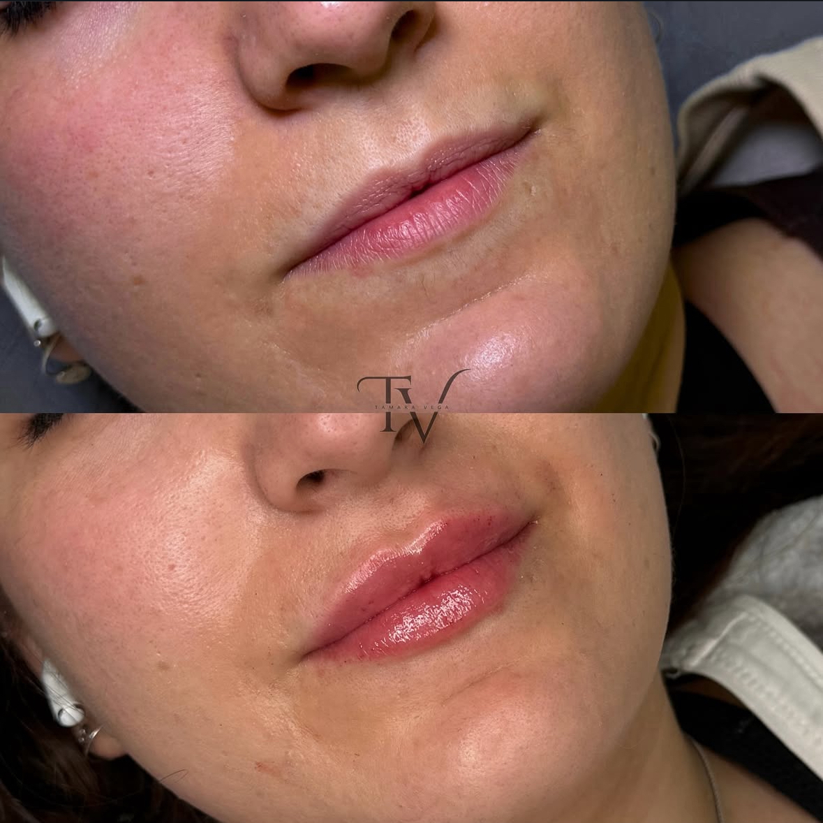 Tratamiento arrugas