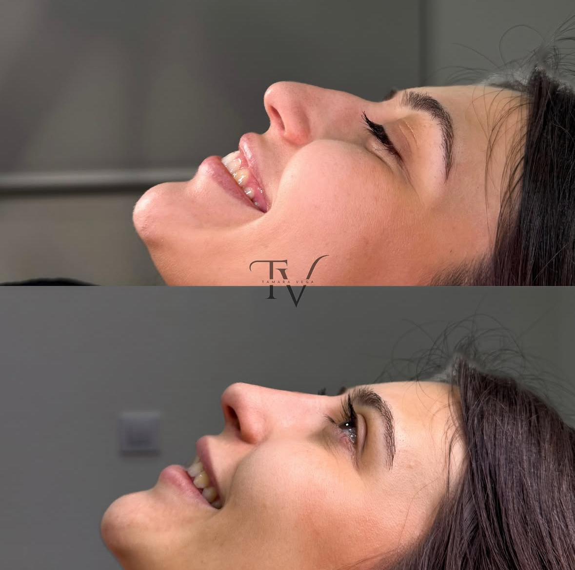 Tratamiento arrugas