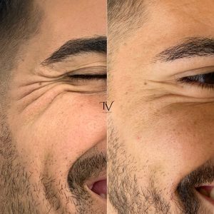 Tratamiento arrugas
